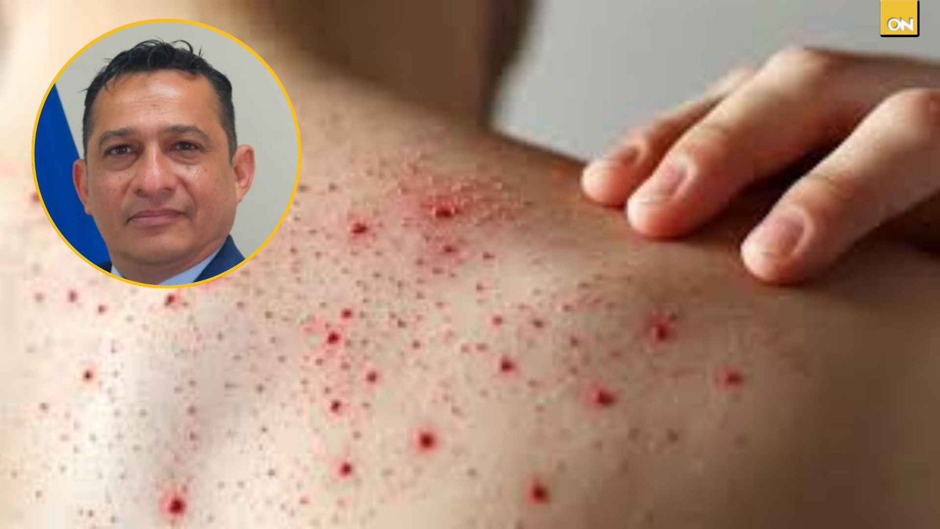 Honduras confirma cuarto caso importado de sarampión