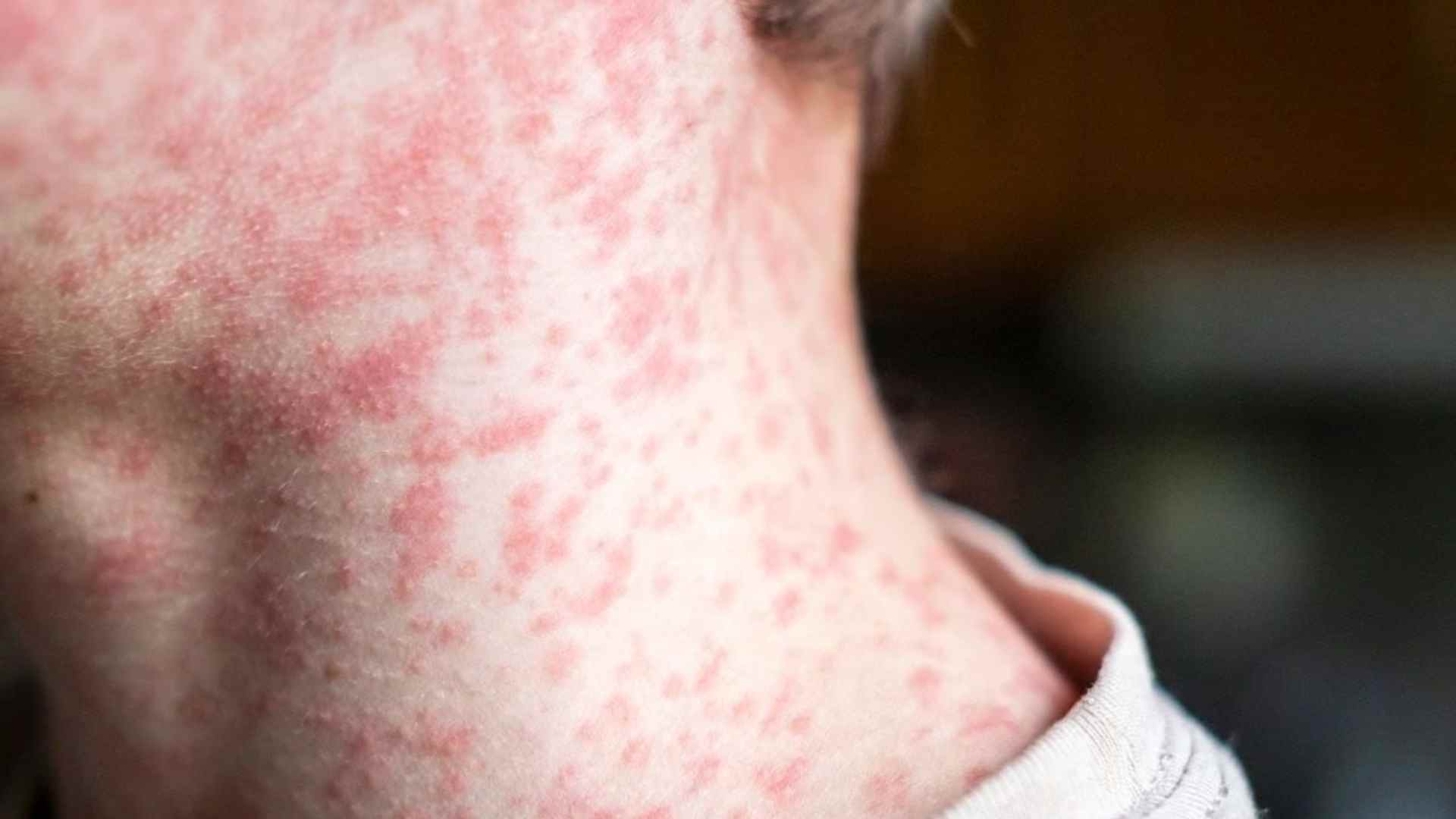 Autoridades de Salud invitan a vacunarse contra el sarampión: estos son los síntomas