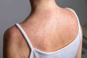 Epidemia de sarampión en Honduras