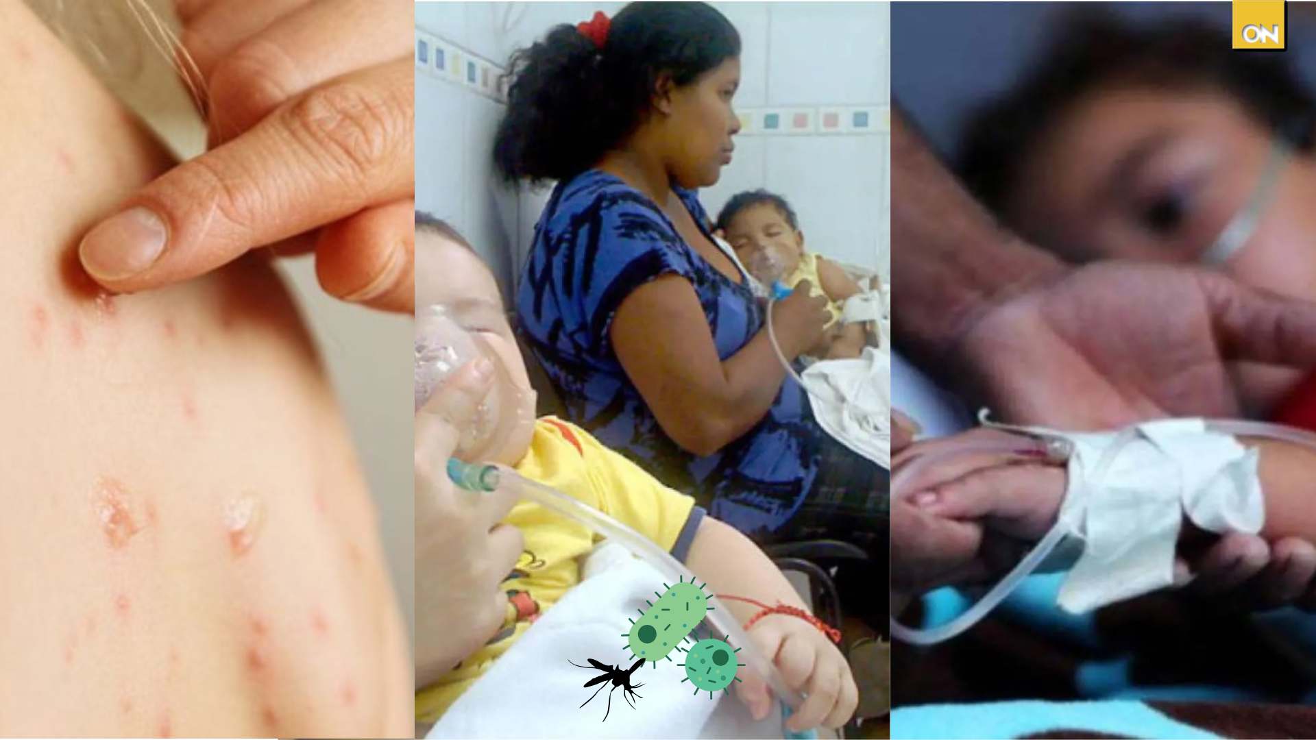 ¿Cuál es la más letal? Dengue, tosferina o sarampión tres epidemias simultáneas en Honduras
