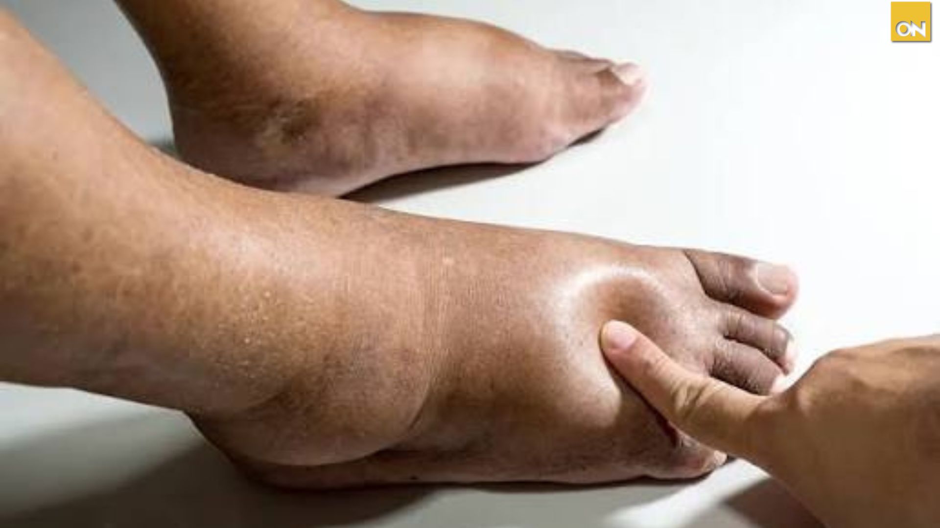El Consultorio: Piernas hinchadas ¿riñones o circulación?