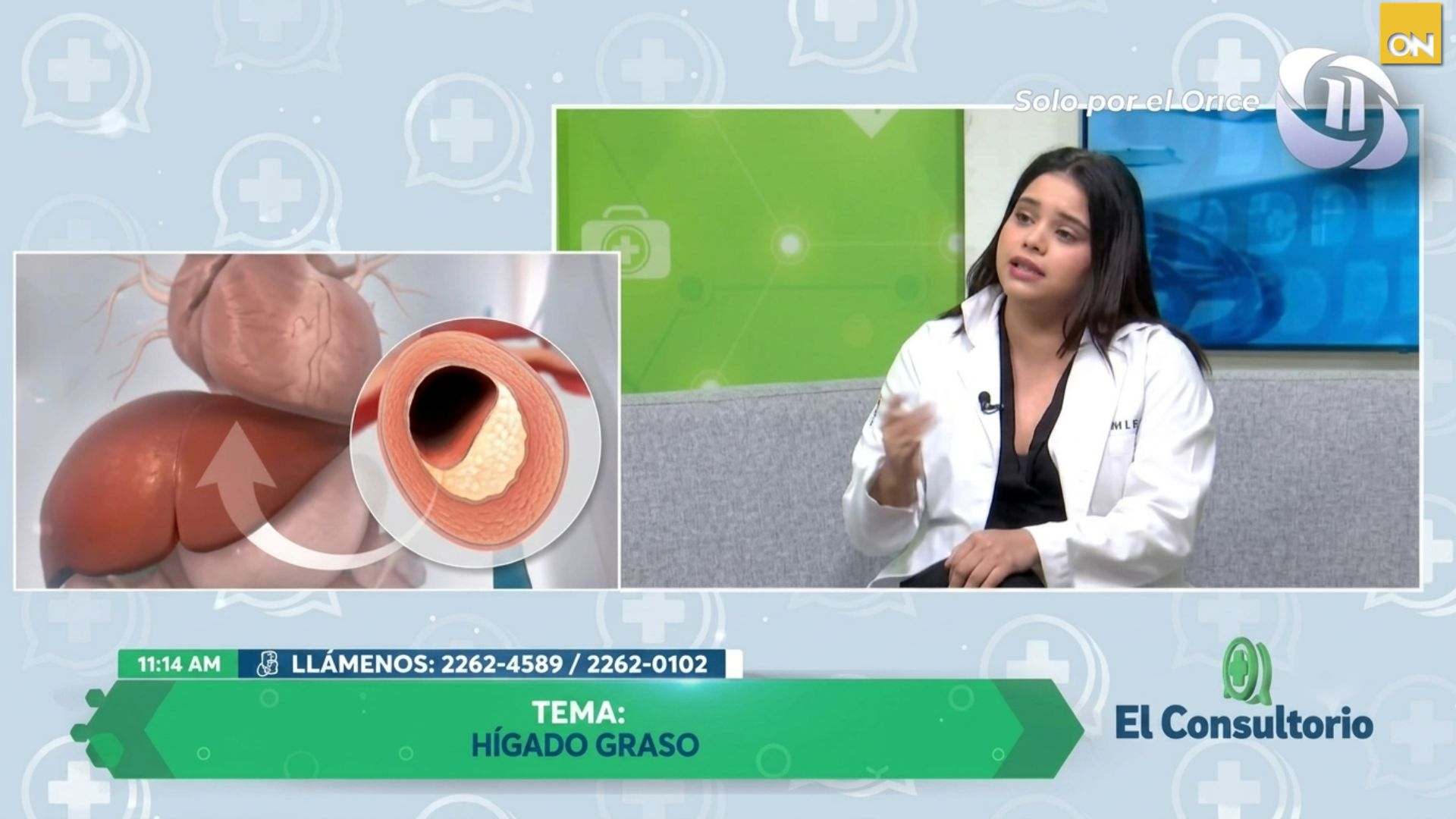 El Consultorio: cómo prevenir el hígado graso