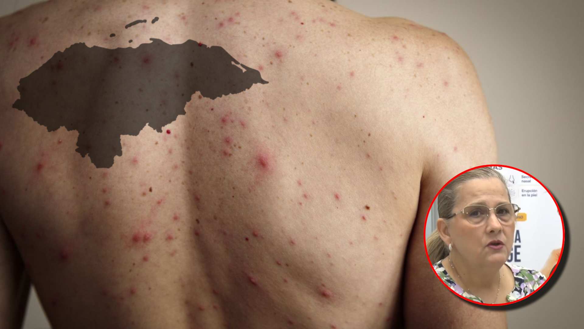 Nuevos casos sospechosos de sarampión en Honduras